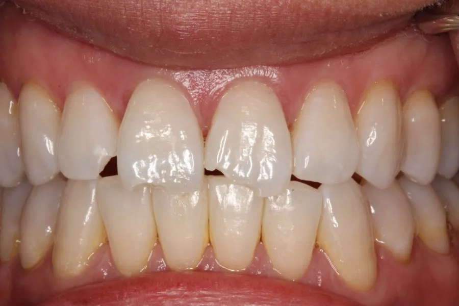 Chipped front teeth before treatment