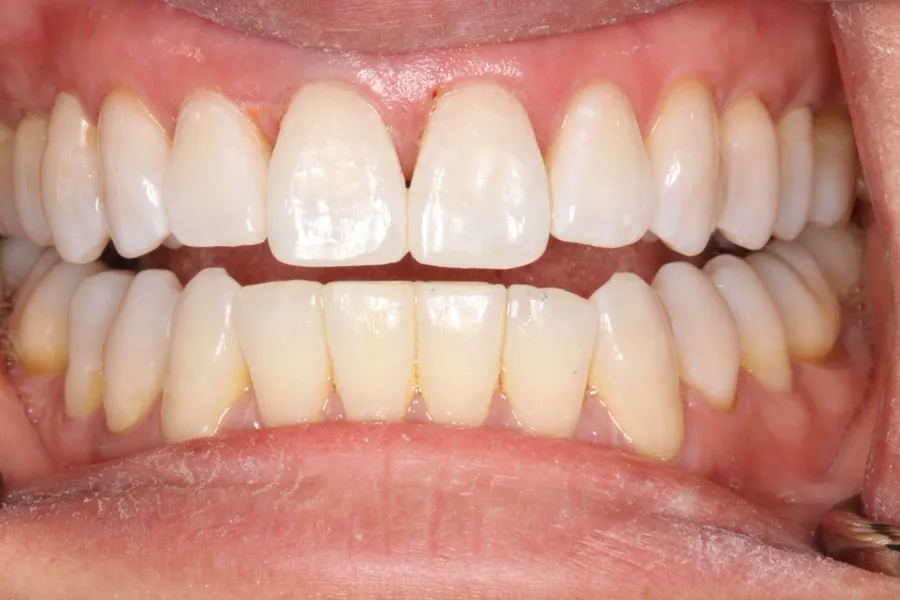 Front teeth repaired, even and natural