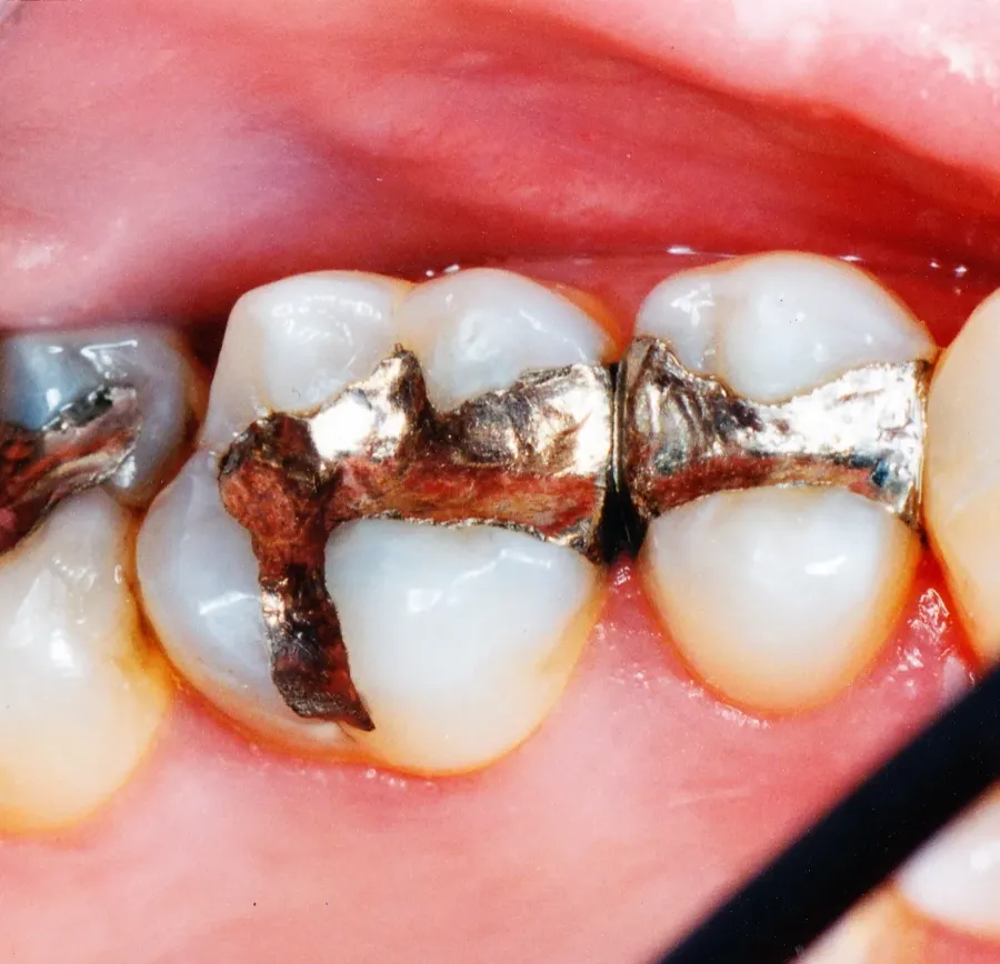 Old silver fillings before replacement