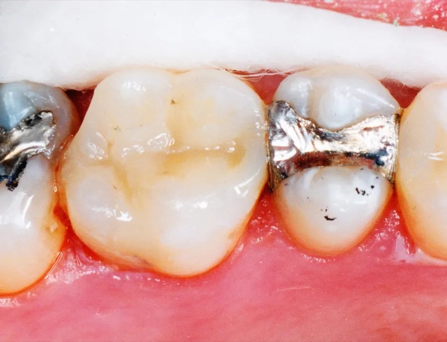 Tooth-colored restorations after