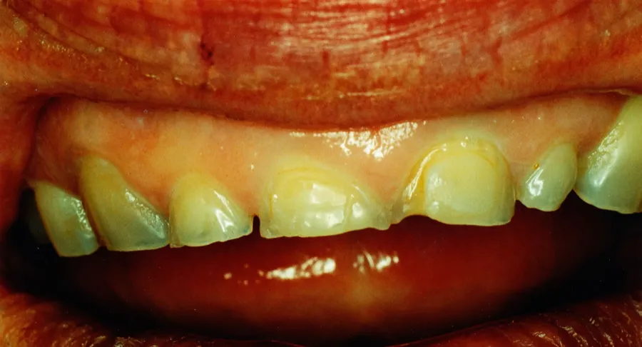 Worn, discolored smile before veneers