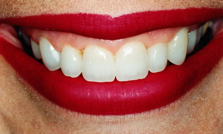 Porcelain veneer smile after