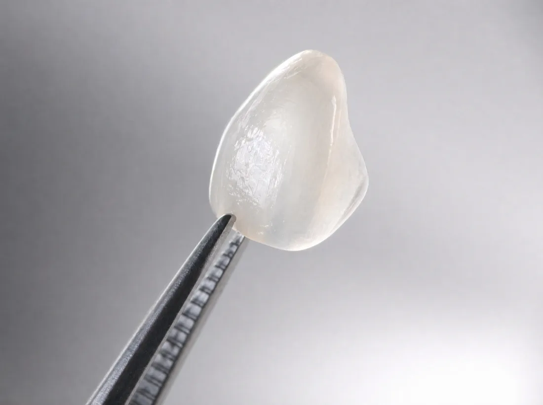 Ultra-thin porcelain, lab-crafted